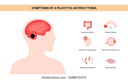 Pilocytic astrocytoma symptoms in child vector. Type of primary central nervous system tumor. Cerebellum disease. Neoplasm in the child silhouette. Problems with balance, coordination, and optic nerve