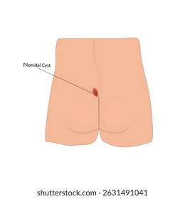 Pilonidal cyst infection vector illustration