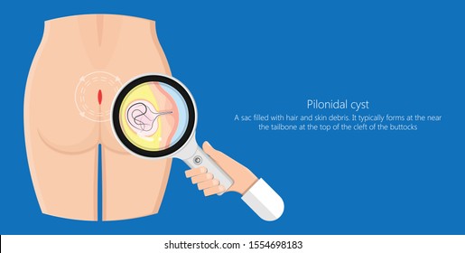 Pilonidal cyst nest of hair causes from excessive prolonged sitting diagnose and treatment