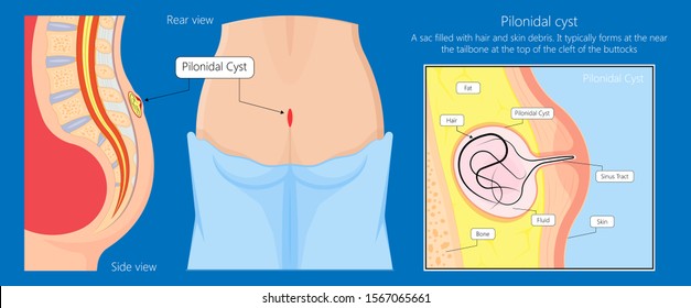 Pilonidal Cyst High Res Stock Images Shutterstock