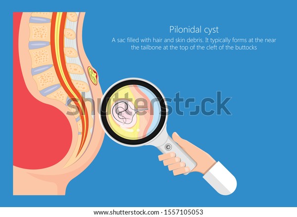 Pilonidal Cyst Nest Hair Causes Excessive Stock Vector Royalty Free