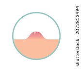 A pimple rises above the skin, circle illustration. Purulent inflammation on the surface of the skin. Vector illustration, flat minimal color cartoon design, isolated on white background, eps 10.
