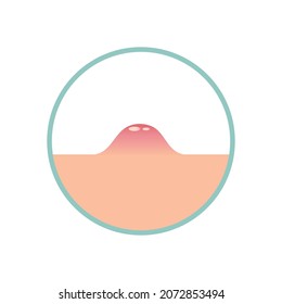 A pimple rises above the skin, circle illustration. Purulent inflammation on the surface of the skin. Vector illustration, flat minimal color cartoon design, isolated on white background, eps 10.