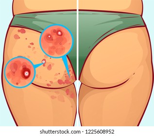 Pimples on the buttocks, before-after. Vector illustration