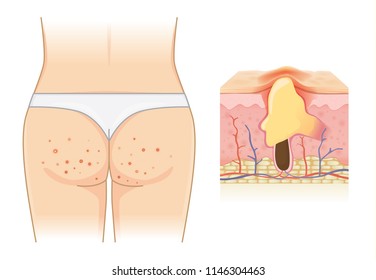 Pimples on buttocks and skin layer with acne isolated on white. Illustration about Dermatology.