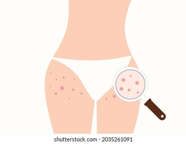 Pimples on buttocks and zoom with magnifier. Skin care concept.