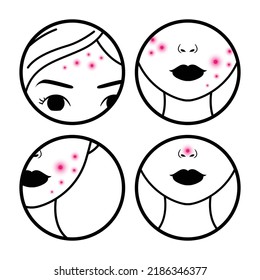 Pimples on the Face. Problematic Skin on the Cheeks, Nose and Forehead. Acne. Parts of a Woman Face. Black White Pink Color. Line Stroke style. Vector illustration for Beauty and Medical Design.