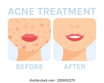 Pimples on a Woman Face. Treatment of Acne on Cheeks and Chin. Before and After. Healthy Clear Skin. Smile. Color Cartoon style. White background. Vector illustration for Medical and Beauty Design.