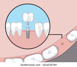A pin molar implant on the pin and jaw before and after visiting the dental clinic. A vector stock illustration with teeth for treatment by an orthodontist or dentist.