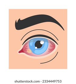 Pinguecula Human Eye Disease Vector Illustration