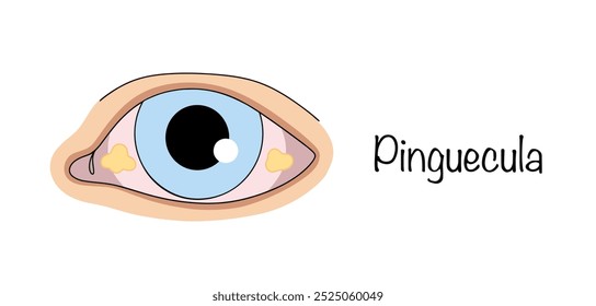 Pinguécula. Neoplasias en la conjuntiva del ojo en forma de crecimiento amarillento. Una simple Ilustración vectorial de color sobre el tema de las enfermedades oculares.