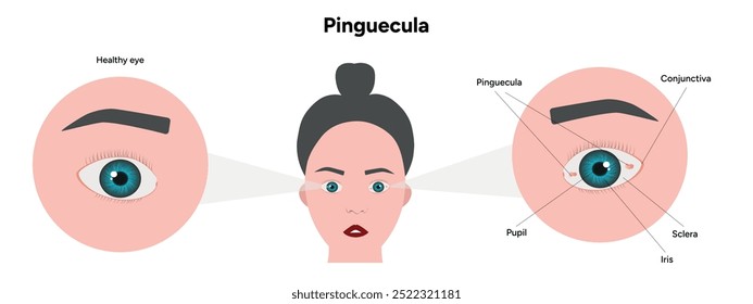 Manchas amarelas pinguéculas no olho. Problema oftalmológico