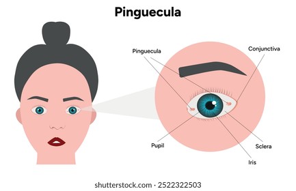 Manchas amarelas pinguéculas no olho. Problema oftalmológico