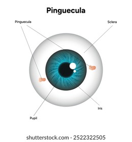 Manchas amarelas pinguéculas no olho. Problema oftalmológico