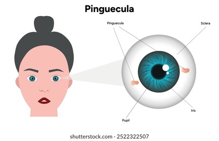 Manchas amarelas pinguéculas no olho. Problema oftalmológico