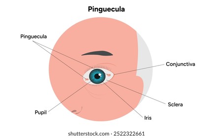 Manchas amarelas pinguéculas no olho. Problema oftalmológico