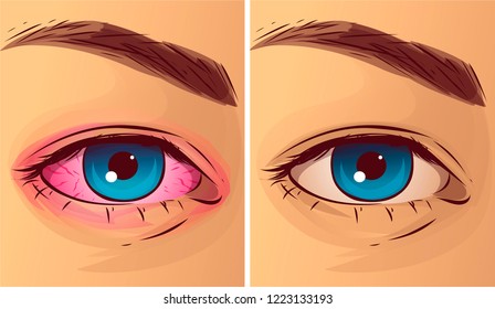 Pink eye, before-after. Vector illustration