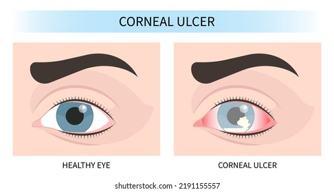 pink red surfer's eye blurry ulcer bacteria lens vision loss pain sores tear drop scars trauma conjunctival cyst swelling itchy dry uvea Stye injury
hordeolum pimple cellulitis pupil iris Anterior