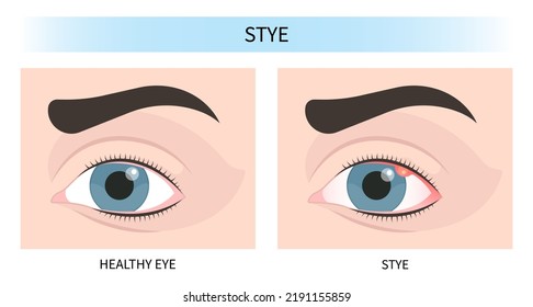 pink red surfer's eye blurry ulcer bacteria lens vision loss pain sores tear drop scars trauma conjunctival cyst swelling itchy dry uvea Stye injury
hordeolum pimple cellulitis pupil iris Anterior