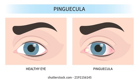pink red surfer's eye blurry ulcer bacteria lens vision loss pain sores tear drop scars trauma conjunctival cyst swelling itchy dry uvea Stye injury
hordeolum pimple cellulitis pupil iris Anterior