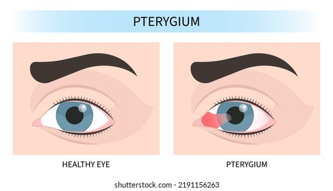 pink red surfer's eye blurry ulcer bacteria lens vision loss pain sores tear drop scars trauma conjunctival cyst swelling itchy dry uvea Stye injury
hordeolum pimple cellulitis pupil iris Anterior