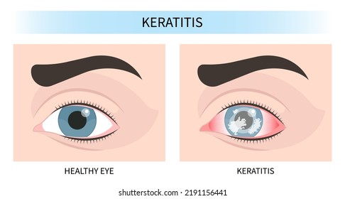 pink red surfer's eye blurry ulcer bacteria lens vision loss pain sores tear drop scars trauma conjunctival cyst swelling itchy dry uvea Stye injury
hordeolum pimple cellulitis pupil iris Anterior