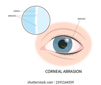 pink red surfer's eye blurry ulcer bacteria lens vision loss pain sores tear drop scars trauma conjunctival cyst swelling itchy dry uvea Stye injury
hordeolum pimple cellulitis pupil iris Anterior