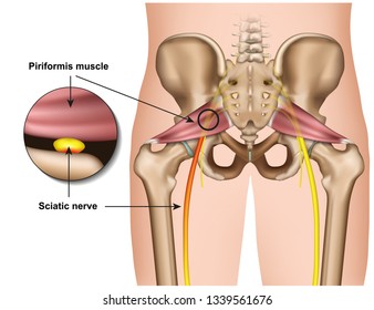 piriformis syndrome 3d medical vector illustration on white background