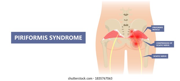 Piriformis syndrome Piriformis Syndrome