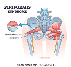 Piriformis syndrome and sciatic nerve compression pain cause outline diagram. Labeled educational medical body back disease explanation with anatomical skeletal and muscle scheme vector illustration.