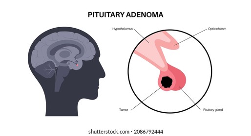Pituitary adenoma concept. Tumor in the human brain. Disease or cancer in the head. Hypothalamus problem. Posterior and anterior pituitary gland anatomy. Medical flat vector illustration for clinic