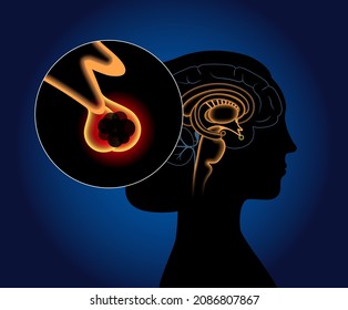 Pituitary adenoma concept. Tumor in the human brain. Disease or cancer in the head. Hypothalamus problem. Posterior and anterior pituitary gland anatomy. Medical flat vector illustration for clinic