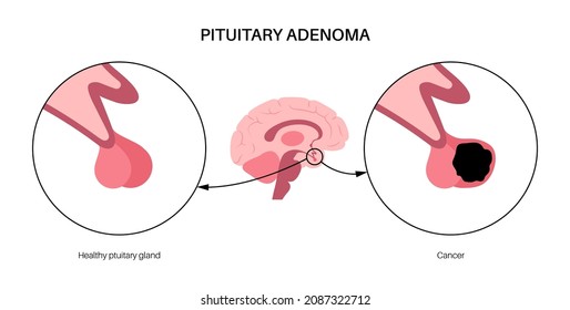Pituitary adenoma concept. Tumor in the human brain. Disease or cancer in the head. Hypothalamus problem. Posterior and anterior pituitary gland anatomy. Medical flat vector illustration for clinic