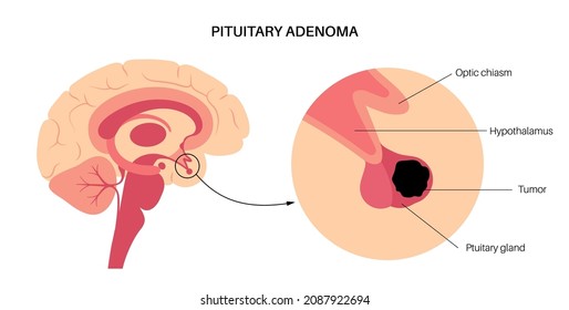 Pituitary adenoma concept. Tumor in the human brain. Disease or cancer in the head. Hypothalamus problem. Posterior and anterior pituitary gland anatomy. Medical flat vector illustration for clinic