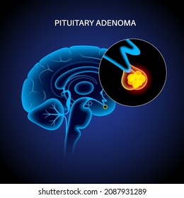 Pituitary adenoma concept. Tumor in the human brain. Disease or cancer in the head. Hypothalamus problem. Posterior and anterior pituitary gland anatomy. Medical flat vector illustration for clinic
