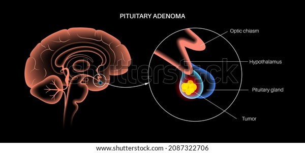 Pituitary Adenoma Concept Tumor Human Brain Stock Vector Royalty Free 2087322706 Shutterstock 7780