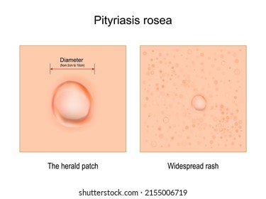 Pityriasis rosea. close-up of skin rash. Signs and symptoms. The herald patch and Widespread rash. vector illustration