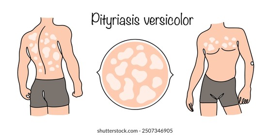 Pityriasis versicolor. A fungal infection that causes a colored rash to appear on the skin. A man with manifestations of the disease on his body. Curable dermatological disease. Vector illustration.