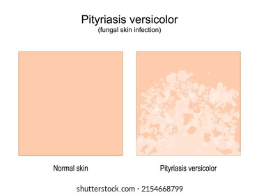 Pityriasis versicolor. fungal skin infection. comparison of Healthy skin and tinea versicolor. Vector illustration