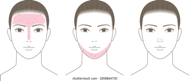 T Zone Face Images Stock Photos Vectors Shutterstock