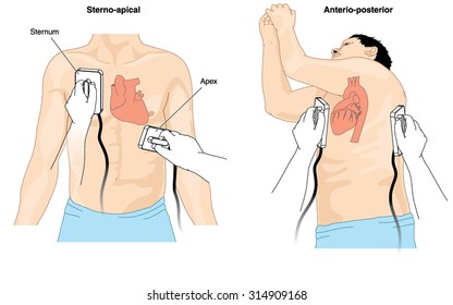 Placement Of Defibrillator Electrode Paddles To Perform Cardioversion On A Patient With Cardiac Arrhythmia