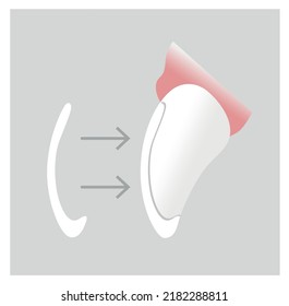 Placement of dental ceramic veneer on a tooth. Dental Aesthetics. Profile view, cross section. Dentist. Vector illustration.