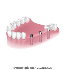 Placement of implants for reconstruction of teeth on the lower jaw. Dental surgery for the placement of metal posts. Vector illustration