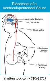 Placement Of A Ventriculoperitoneal Shunt