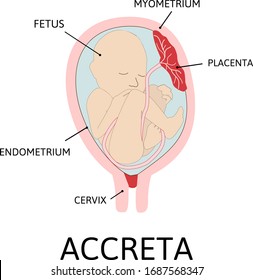 Placenta accreta. part of placenta attaches abnormally to the myometrium. grade of abnormal attachment illustrated according to the depth: Accrete. colored medical vector illustration