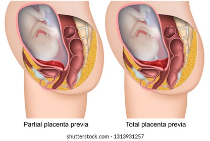 Placenta brevia pregnancy 3d vector illustration on white background