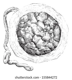 Placenta (external Or Uterine Side), Vintage Engraved Illustration. Usual Medicine Dictionary By Dr Labarthe - 1885.