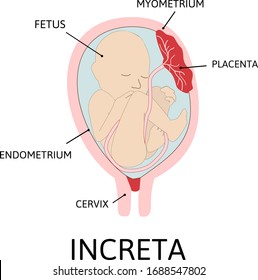 Placenta increta. part of placenta attaches abnormally to the myometrium. grade of abnormal attachment illustrated according to the depth: Accrete. colored medical vector illustration