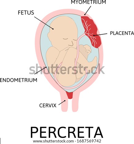 Placenta percreta. part of placenta attaches abnormally to the myometrium. grade of abnormal attachment illustrated according to the depth: Accrete. colored medical vector illustration