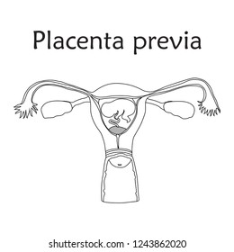 Placenta previa. Embryo, fetus in uterus, placenta, umbilical cord. Vector medical illustration. Thin line image, white background.